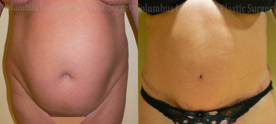Abdominoplasty (Tummy Tuck) before and after photo by Columbus Institute of Plastic Surgery in Columbus, OH