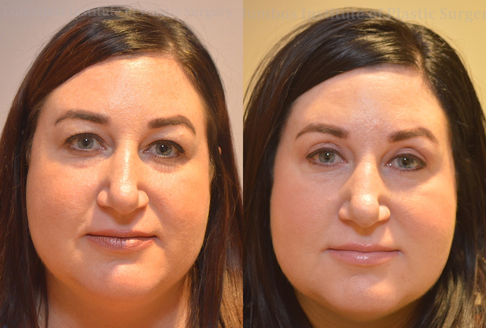Blepharoplasty before and after photo by Columbus Institute of Plastic Surgery in Columbus, OH