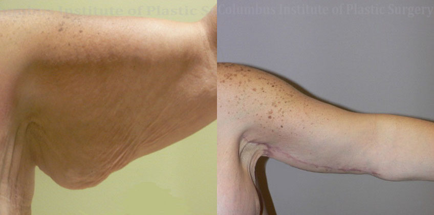 Brachioplasty (Arm Lift) before and after photo by Columbus Institute of Plastic Surgery in Columbus, OH