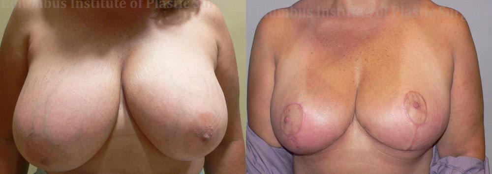 Breast Reduction before and after photo by Columbus Institute of Plastic Surgery in Columbus, OH