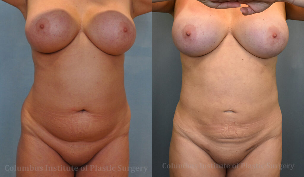 Liposuction before and after photo by Columbus Institute of Plastic Surgery in Columbus, OH