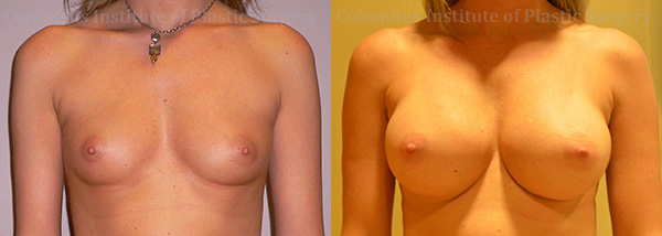 Breast Augmentation – 400cc-500cc before and after photo by Columbus Institute of Plastic Surgery in Columbus, OH