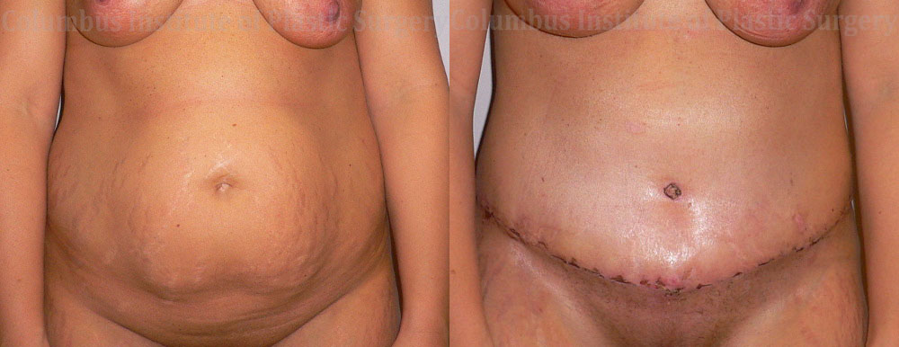 Abdominoplasty (Tummy Tuck) before and after photo by Columbus Institute of Plastic Surgery in Columbus, OH