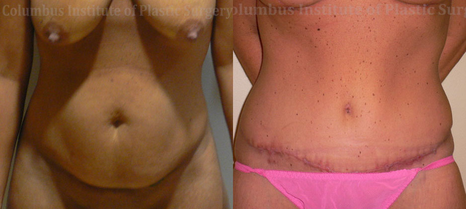 Abdominoplasty (Tummy Tuck) before and after photo by Columbus Institute of Plastic Surgery in Columbus, OH