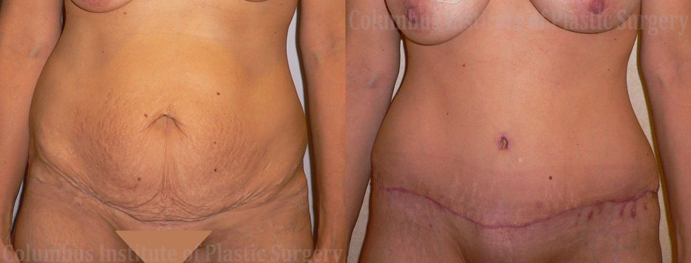 Abdominoplasty (Tummy Tuck) before and after photo by Columbus Institute of Plastic Surgery in Columbus, OH