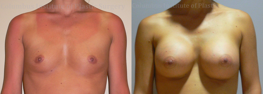 Breast Augmentation – 400cc-500cc before and after photo by Columbus Institute of Plastic Surgery in Columbus, OH