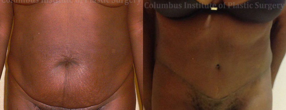 Abdominoplasty (Tummy Tuck) before and after photo by Columbus Institute of Plastic Surgery in Columbus, OH