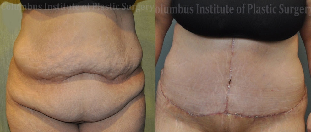 Abdominoplasty (Tummy Tuck) before and after photo by Columbus Institute of Plastic Surgery in Columbus, OH