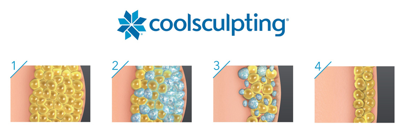 CoolSculpting Illustration Process