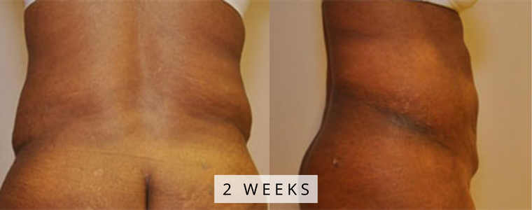 Liposuction Before and After Results wks