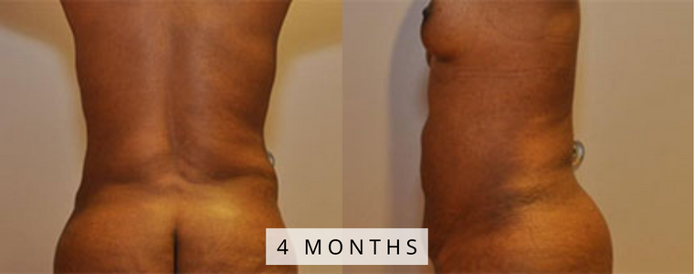 Liposuction Before and After Results mo