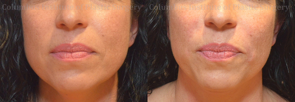 Fillers and Botox before and after photo by Columbus Institute of Plastic Surgery in Columbus, OH