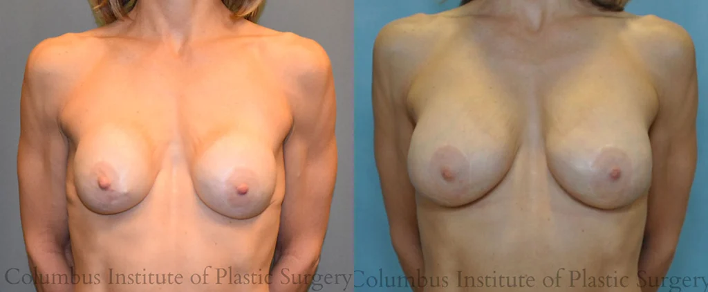 Breast Implant Exchange before and after photo by Columbus Institute of Plastic Surgery in Columbus, OH