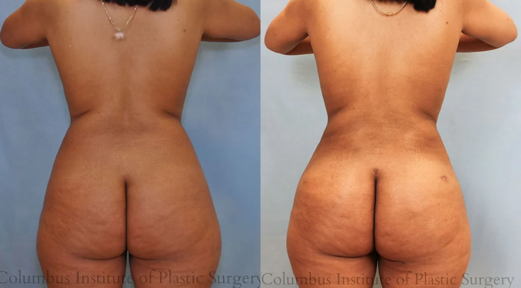 Liposuction before and after photo by Columbus Institute of Plastic Surgery in Columbus, OH