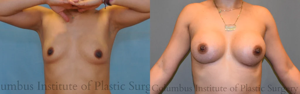 Breast Augmentation before and after photo by Columbus Institute of Plastic Surgery in Columbus, OH