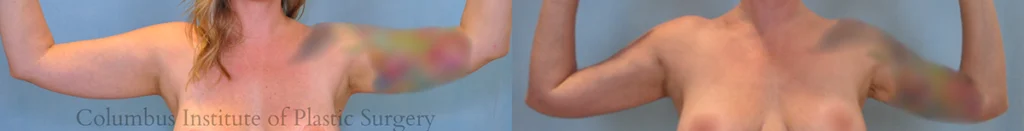 Liposuction before and after photo by Columbus Institute of Plastic Surgery in Columbus, OH