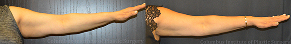 CoolSculpting before and after photo by Columbus Institute of Plastic Surgery in Columbus, OH