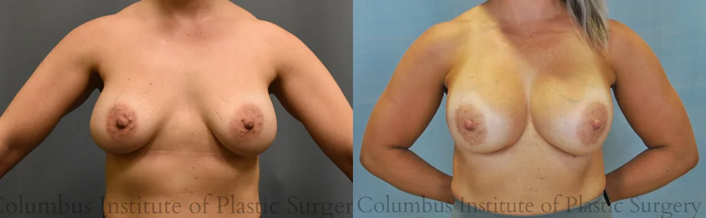 Breast Implant Exchange before and after photo by Columbus Institute of Plastic Surgery in Columbus, OH