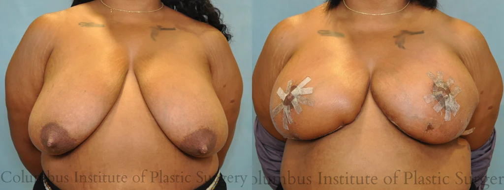 Breast Reduction before and after photo by Columbus Institute of Plastic Surgery in Columbus, OH