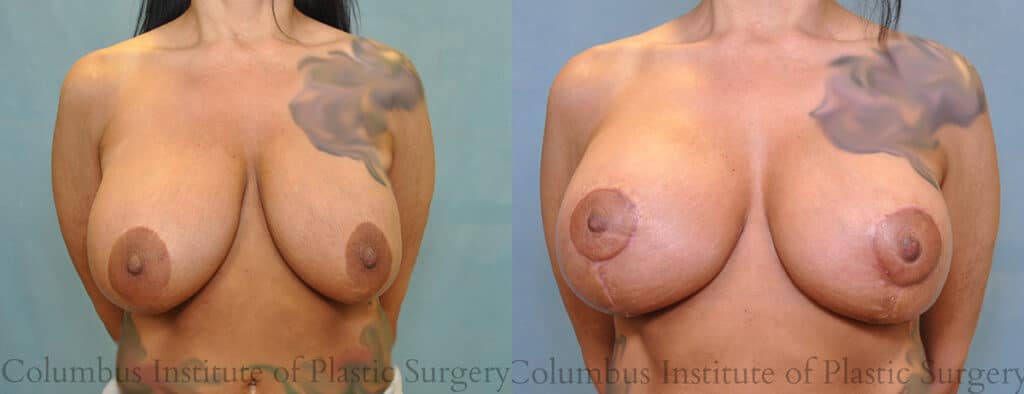 Mastopexy with Implants before and after photo by Institute of Plastic Surgery in Columbus OH
