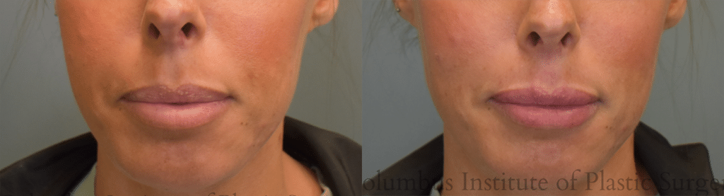 Fillers and Botox before and after photo by Columbus Institute of Plastic Surgery in Columbus OH
