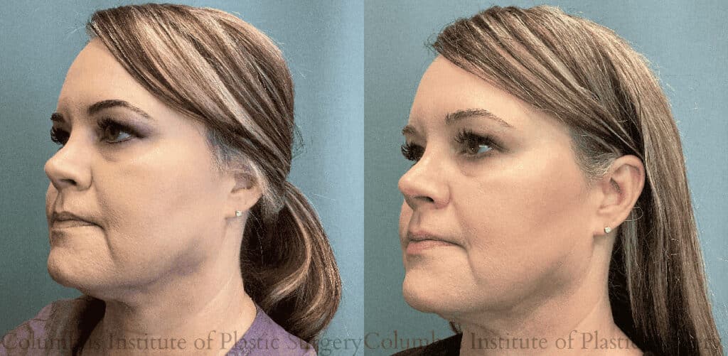 Chin Liposuction before and after photo by Institute of Plastic Surgery in Columbus OH