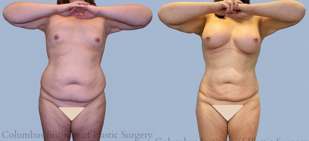 Liposuction before and after photo by Institute of Plastic Surgery in Columbus OH
