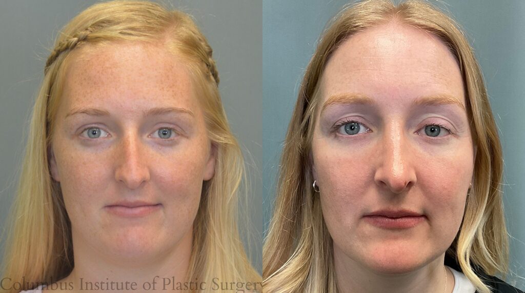 Rhinoplasty before and after photo by Institute of Plastic Surgery in Columbus OH