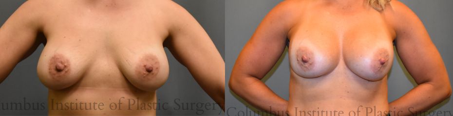 Breast Augmentation before and after photo by Columbus Institute of Plastic Surgery in Columbus OH