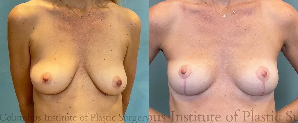 Breast Lift before and after photo by Institute of Plastic Surgery in Columbus OH