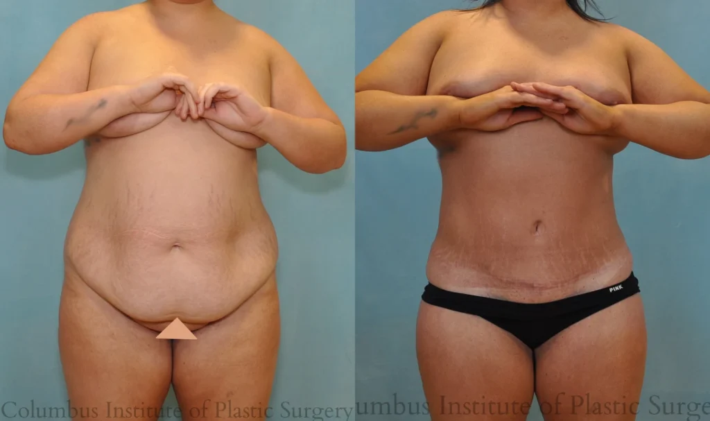 Abdominoplasty Tummy Tuck before and after photo by Columbus Institute of Plastic Surgery in Columbus OH