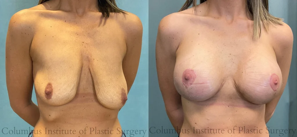 Breast Lift before and after photo by Institute of Plastic Surgery in Columbus OH