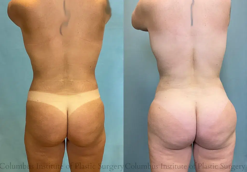 Back View Liposuction before and after photo by Institute of Plastic Surgery