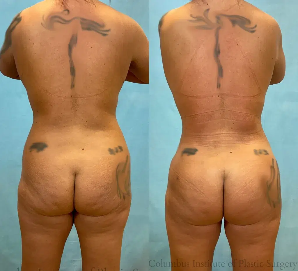 Back View Liposuction before and after photo by Institute of Plastic Surgery