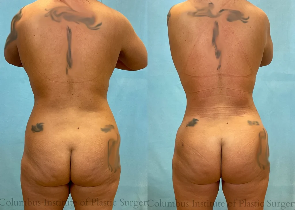 Back View Fat Grafting to Buttock before and after photo by Institute of Plastic Surgery